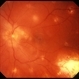 Multifocal Choroiditis and Panuveitis Syndrome